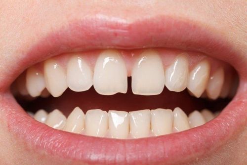 Why are teeth sparse?