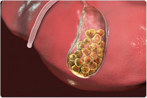 
Sỏi cholesterol trong túi mật là loại sỏi phổ biến được hình thành vì sự không tan của cholesterol
