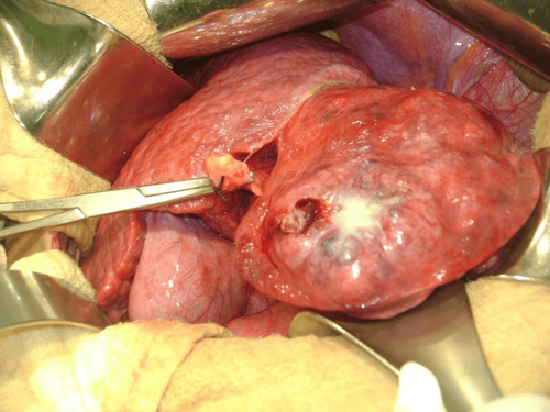 Beware of gallstones in the liver causing biliary obstruction