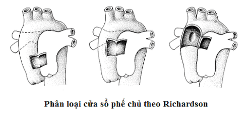 
Phân loại cửa sổ phế chủ theo Richardson
