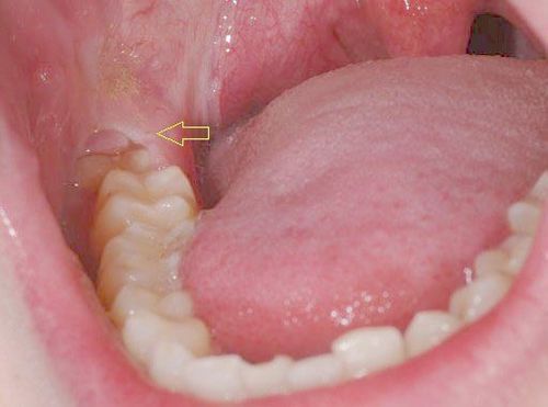 
Sau khi nhổ răng khôn, bạn có thể sẽ bị sưng tấy và khó chịu
