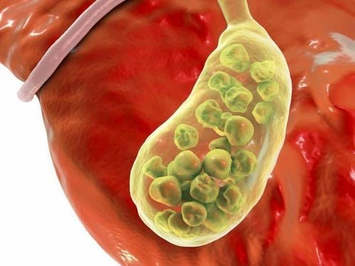 Is gallbladder sludge curable?