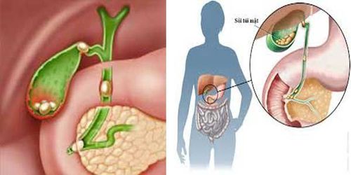 Điều trị ung thư túi mật giai đoạn 3 di căn gan thế nào?