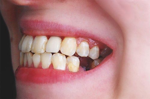 Can people with missing teeth get braces?