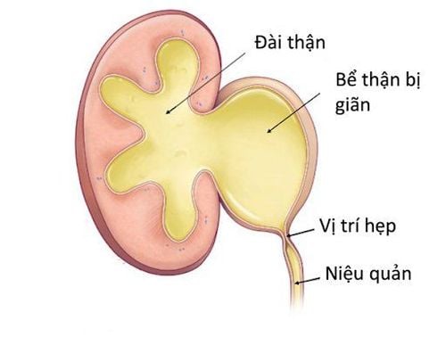 Điều trị giãn bể thận như thế nào?