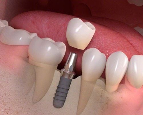 
Người bị mất răng vĩnh viễn có thể trồng răng Implant
