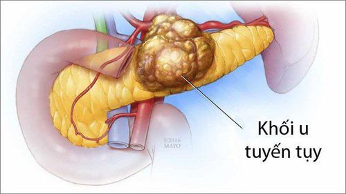 K tụy thể có điều trị theo phương pháp ghép tế bào gốc máu tự thân được không?