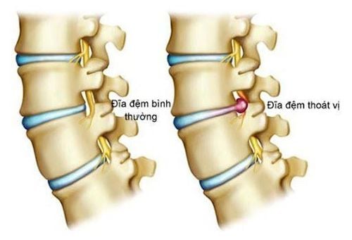 Thoát vị đĩa đệm đa tầng cổ tuổi 51 có làm được phương pháp đổ xi măng không?