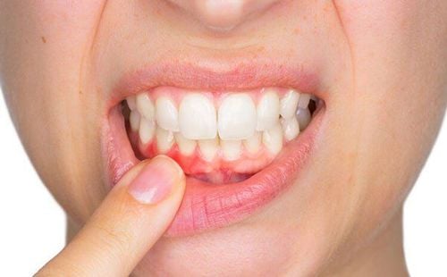 Bệnh nướu răng và bệnh tim: Mối liên hệ là gì?