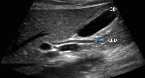 Dilatation of intrahepatic biliary tract on ultrasound