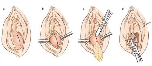 Phẫu thuật u nang tuyến Bartholin có điều trị dứt điểm được không?