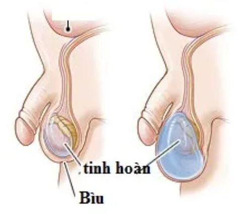 
Tình trạng một túi mỏng giữ tinh hoàn xuất hiện trong bệnh thủy tinh mạc ở trẻ
