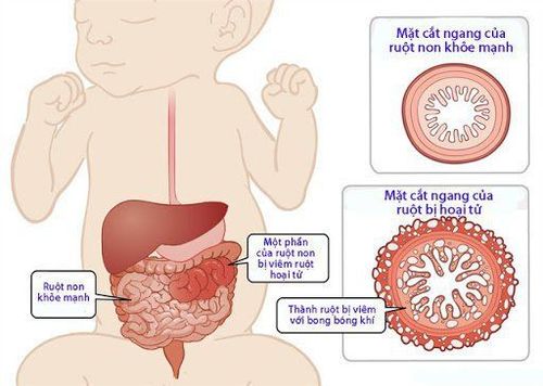 
Hình ảnh mô tả viêm ruột hoại tử ở trẻ sơ sinh
