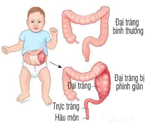 Phình đại tràng bẩm sinh có nên phẫu thuật sớm không?