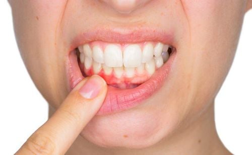 Các biện pháp khắc phục tại nhà khi chảy máu nướu răng
