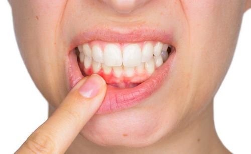 Home remedies for bleeding gums