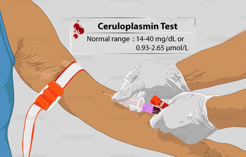 
Xét nghiệm ceruloplasmin giúp bác sĩ chẩn đoán bệnh Wilson
