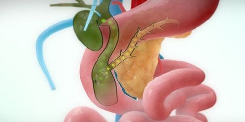 Complications of common bile duct cysts