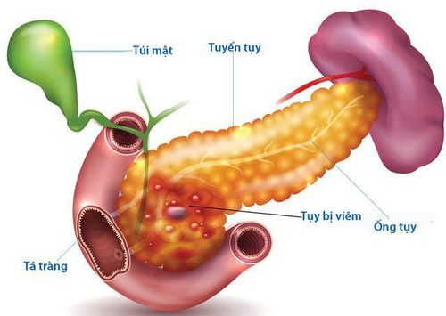 
Nang ống mật chủ có thể gây biến chứng viêm tụy cấp
