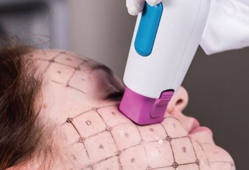 
Sử dụng công nghệ Thermage có giúp săn chắc da hơn
