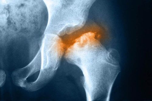 Bệnh hoại tử xương là gì?