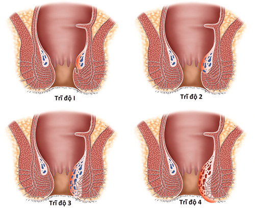 How long does it take to cure grade 3 hemorrhoids?