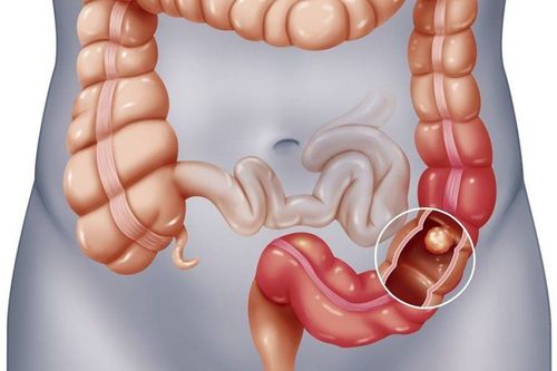 What technique can be used to diagnose colon polyps?