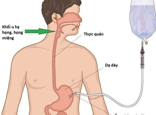 Đang đặt ống thông dạ dày có thể ăn được không?