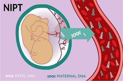 What is the result of NIPT Monosomy X 9% test during pregnancy?