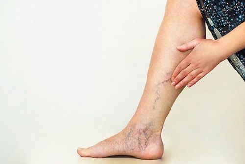 Are you a "best friend" of varicose veins?