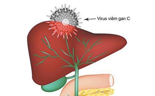 
Bệnh viêm gan c mạn tính có thể tiến triển thành xơ gan
