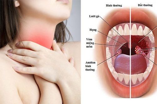 Nữ giới buốt, rát vùng họng sau cắt amidan nguyên nhân là gì?
