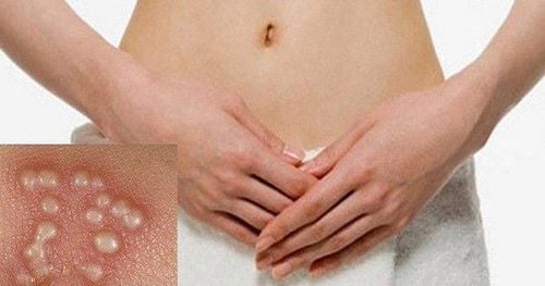 Herpes sinh dục tái phát nhiều lần điều trị thế nào?