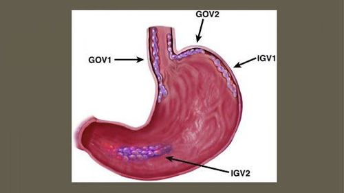 
Chỉ định thắt tĩnh mạch phình vị trong việc xử trí ca bệnh xuất huyết tiêu hóa
