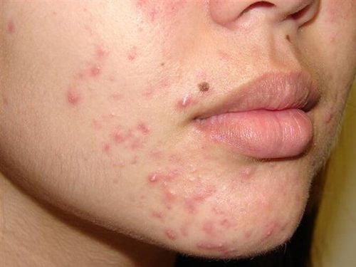 How to treat boils at home?