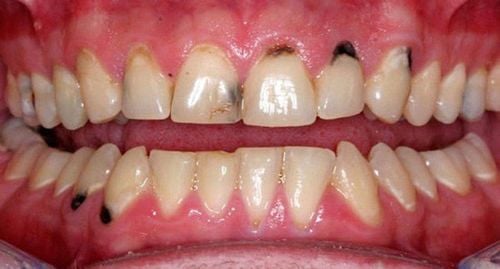 How to remove black spots on teeth