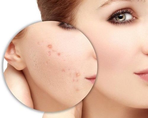 Natural ways to get rid of acne scars