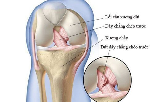 Chế độ tập luyện cho người đứt bán dây chằng chéo trước gối?