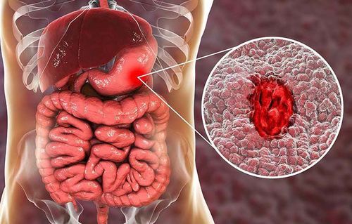 Patients with gastric bleeding due to ulcers should be treated like?