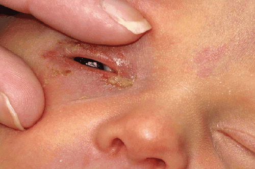 Trẻ 2 tháng tuổi có nhiều ghèn ở mắt phải làm sao?