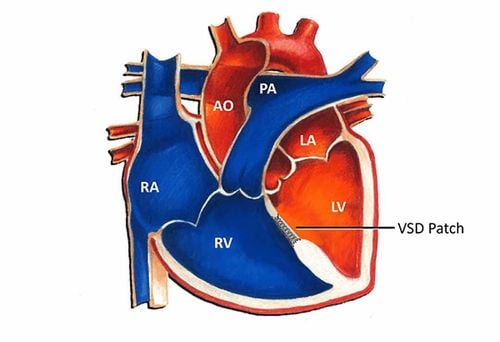 Trẻ sơ sinh thông liên nhĩ thứ phát kích thước 4,5mm nguy hiểm không?