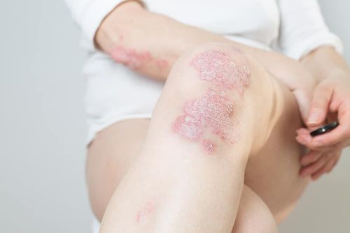 The link between psoriasis and smoking