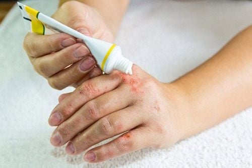 Note when using topical atopic dermatitis