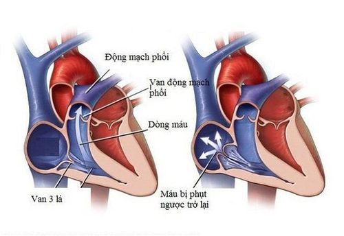 How are patients with mitral regurgitation treated?