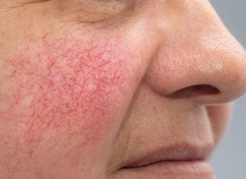 Drugs for the treatment of capillaries in the face