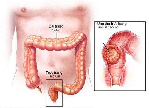 Người bệnh bị khối u ác tính trực tràng ăn uống kém phải làm sao?