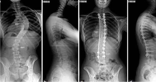 Kết quả chụp X quang cột sống bất thường có nguy cơ mắc bệnh gì?