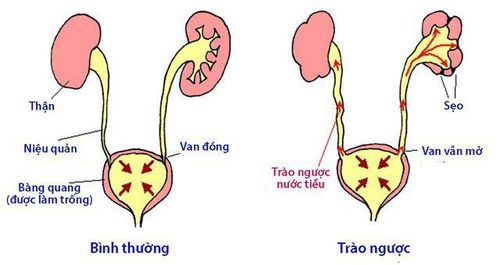 Kỹ thuật nào đánh giá mức độ trào ngược bàng quang niệu quản?