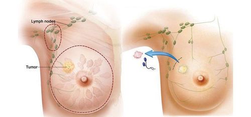 
Điều trị nội tiết trong ung thư vú và những điều cần biết
