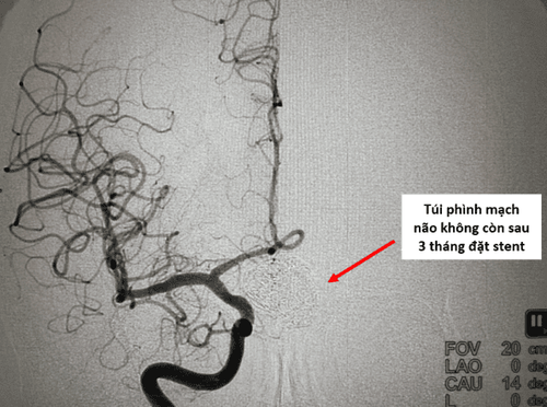 
Ca bệnh thứ 1 – Túi phình mạch não không còn sau 3 tháng điều trị.
